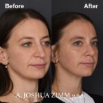 6 Revision Rhinoplasty 3