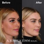 6 Rhinoplasty Before And After 1 1