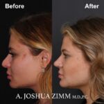 6 Rhinoplasty Before And After 1