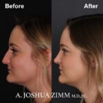 6 Rhinoplasty Before And After 10