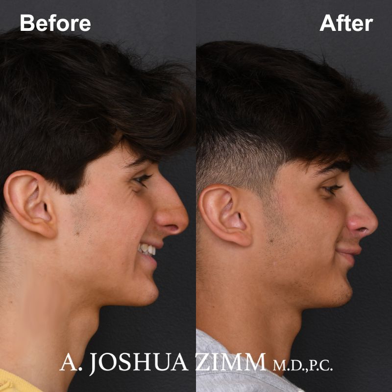 6 Rhinoplasty Before And After 14