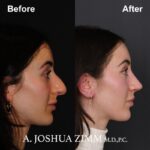 6 Rhinoplasty Before And After 15