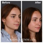 6 Rhinoplasty Before And After 16