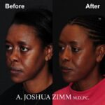6 Rhinoplasty Before And After 17