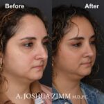6 Rhinoplasty Before And After 18