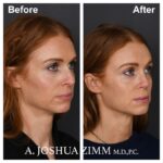 6 Rhinoplasty Before And After 20