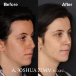 6 Rhinoplasty Before And After 21