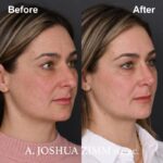 6 Rhinoplasty Before And After 22