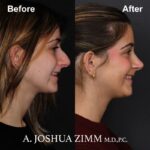 6 Rhinoplasty Before And After 25