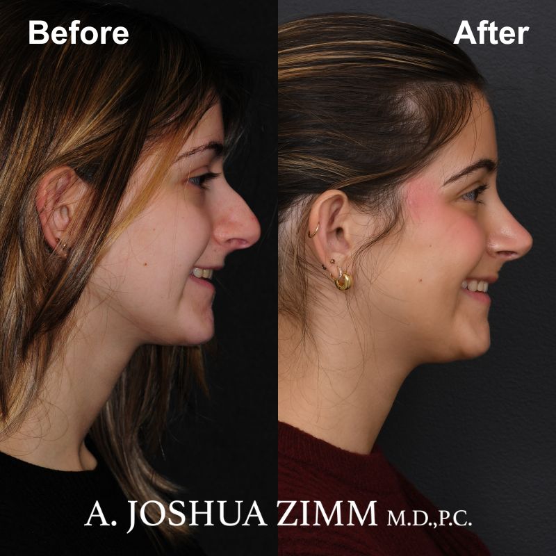 6 Rhinoplasty Before And After 25