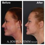 6 Rhinoplasty Before And After 26