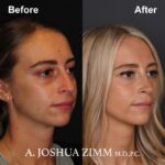 6 Rhinoplasty Before And After 27