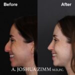 6 Rhinoplasty Before And After 28