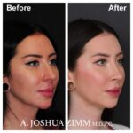 6 Rhinoplasty Before And After 29