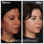6 Rhinoplasty Before And After 32