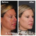 6 Rhinoplasty Before And After 34