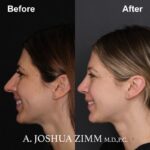 6 Rhinoplasty Before And After 35