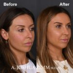6 Rhinoplasty Before And After 37