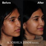 6 Rhinoplasty Before And After 39