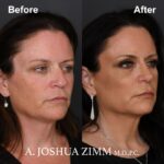 6 Rhinoplasty Before And After 4
