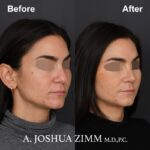 6 Rhinoplasty Before And After 42