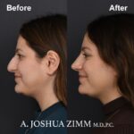 6 Rhinoplasty Before And After 44