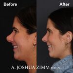 6 Rhinoplasty Before And After 45