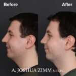6 Rhinoplasty Before And After 46