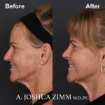 6 Rhinoplasty Before And After 47