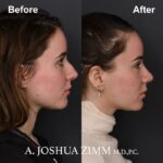 6 Rhinoplasty Before And After 48