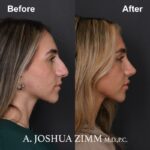 6 Rhinoplasty Before And After 5