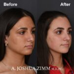 6 Rhinoplasty Before And After 50