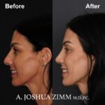 6 Rhinoplasty Before And After 51