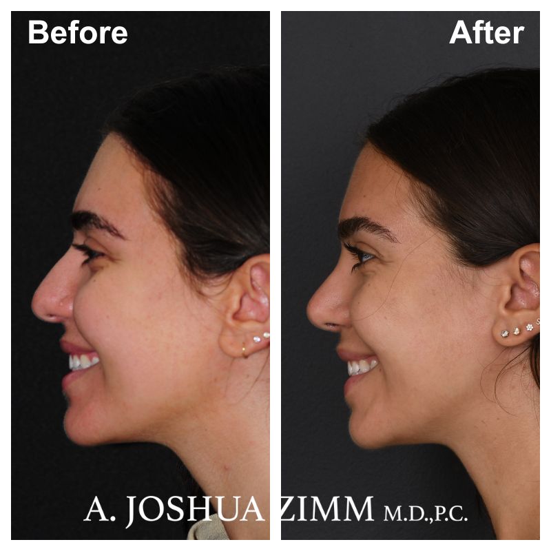6 Rhinoplasty Before And After 52