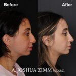 6 Rhinoplasty Before And After 54