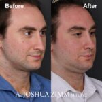 6 Rhinoplasty Before And After 55