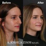 6 Rhinoplasty Before And After 56