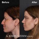 6 Rhinoplasty Before And After 57
