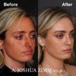 6 Rhinoplasty Before And After 58