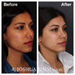 6 Rhinoplasty Before And After 60