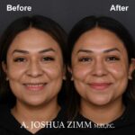 6 Rhinoplasty Before And After 7