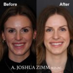 6 Rhinoplasty Before And After 8
