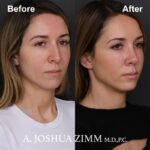 6 Rhinoplasty Before And After 9