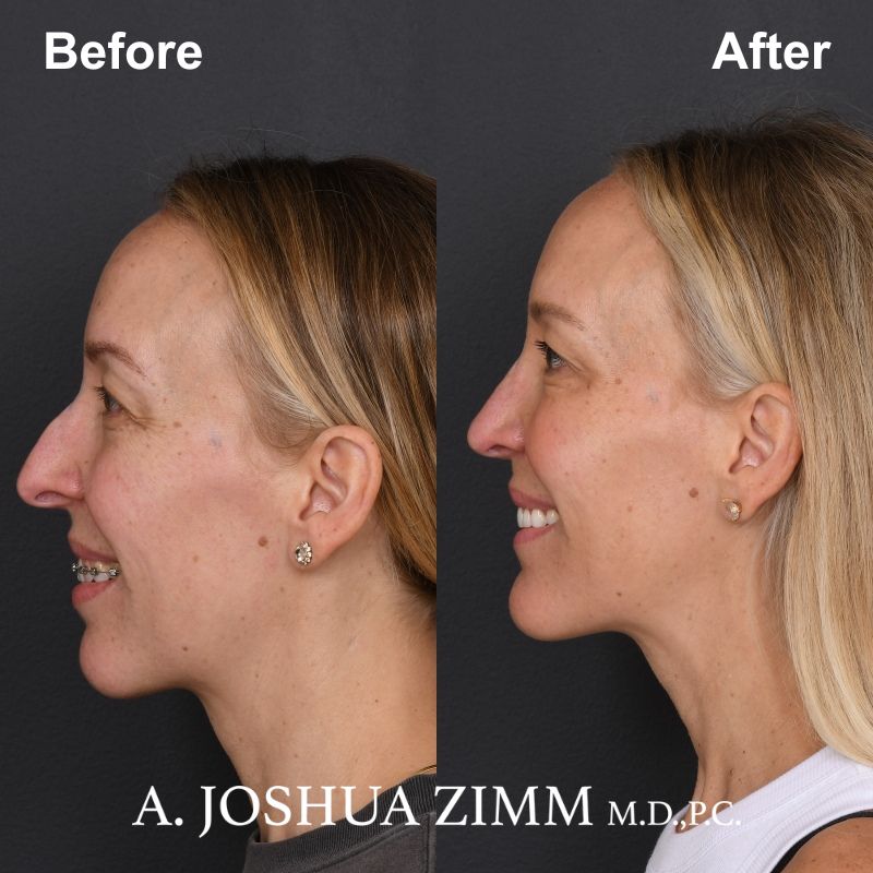 7 Chin Implant Before And After 1