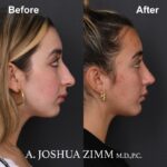 7 Chin Implant Before And After 2 1