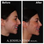 7 Chin Implant Before And After 2