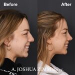 7 Revision Rhinoplasty 1