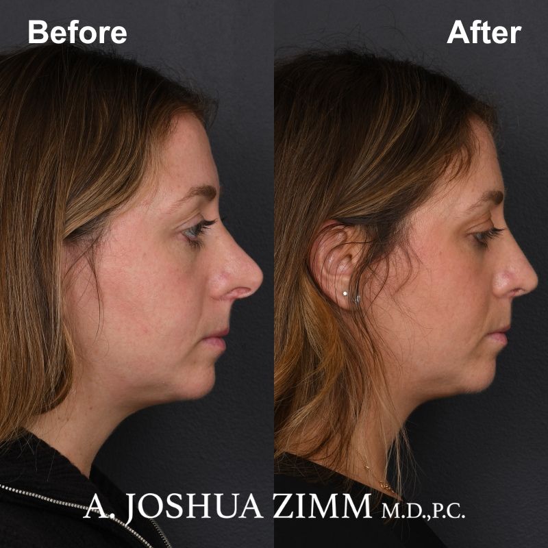 7 Revision Rhinoplasty 2