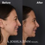 7 Revision Rhinoplasty 3