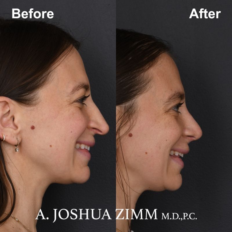 7 Revision Rhinoplasty 3